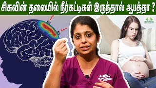 சீறுநீர் தேக்கம் குழந்தையின் kidney யில் இருந்தால் பாதிப்பு ஏற்படுமா   Dr Deepthi Jammi  Cwc [upl. by Pinkham]