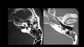 Radiology  Imaging of the Petrous Bone  Skull [upl. by Kamilah245]