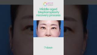 Korean Blepharoplasty recovery process  swelling before and after [upl. by Monagan]