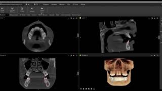 DTX Studio™ Clinic Featuring MagicAssist Virtual Crown Creation [upl. by Onitrof]