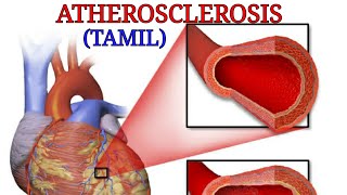 Atherosclerosis in tamil class medics [upl. by Nora]