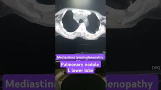 Mediastinal lymphadenopathy on CT scan pulmonary nodule on CT scan [upl. by Aubrey]