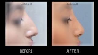 Luis Da Cruz MD  NOSE SURGERY  Before amp After [upl. by Adnauq]