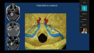 Anatomy and Surgical Approaches to Petrous Bone  Professor Pablo Gonzalez [upl. by Broida517]