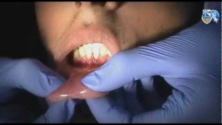 Do It Like a Dentist  Periodontal Examination Course 1  Part 2 [upl. by Lear960]