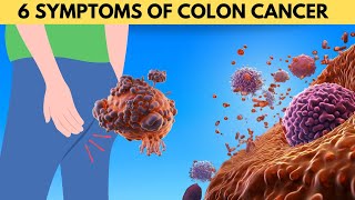 6 Early Warning Signs Of Colon Cancer You Cant Ignore [upl. by Sheffie]