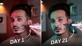 My Scar’s Journey with Dermapen at Home [upl. by Arluene]