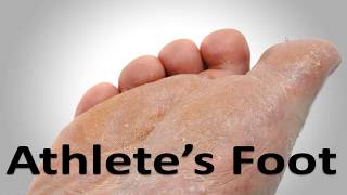 How to help knock out Athletes Foot [upl. by Pouncey332]