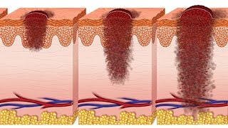 Comment définiton un ulcère de jambe [upl. by Tnomed]