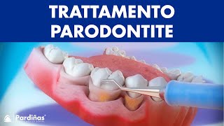 Trattamento parodontite – Curettage e sondaggio parodontale © [upl. by Suolhcin]