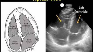 How to Cardiac Ultrasound  Apical View Case Study [upl. by Naot736]