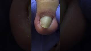 Massive ingrown toenail removal satisfyingvideo pedicure [upl. by Thorvald]