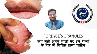 Dr Rudra Mohanगाल पर धब्बे घबराने की जरूरत नहीं हैFordyces Granules इसे दंत चिकित्सक को दिखाएं [upl. by Solraced]