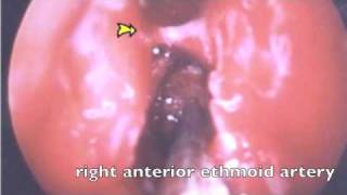 Artery Ligation for Epistaxis [upl. by Nosliw]