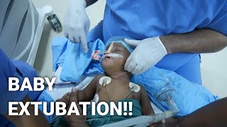 Paediatric Anaesthetics  Extubation of Child after cleft lip surgery [upl. by Aicilaanna392]