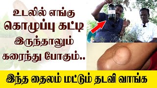 கொழுப்பு கட்டிகளை கரைக்கும் அதிசய மருந்து இதுதான்Lipoma Treatment [upl. by Nawotna]