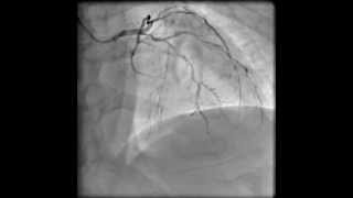 Left coronary angiogram RAO cranial [upl. by Ecirtram368]