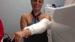 Total Elbow Replacement Surgery Outpatient Procedure  Dr Alejandro Badia Elbow Surgeon [upl. by Vaasta690]