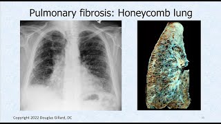 Interstitial Fibrosis amp All About Pathological Auscultatory Breath Sounds Adventitious Sounds [upl. by Anedal]