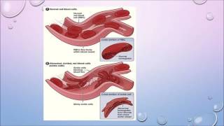 What is Plasmapheresis Susan Main Nurse Clinician [upl. by Ggerg]