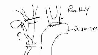 Gallbladder Removal Common Bile Duct Injuries [upl. by China]