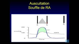 Examen physique cardio vasculaire Partie 3 [upl. by Salahcin240]