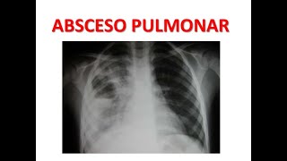 Diagnostico y tratamiento del Absceso Pulmonar MEDICINA INTERNA [upl. by Freddi]