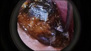 Full Hard Ear Wax Removal Ep4 and How to Unblock Your Ears  UNCLOG a CLOGGED Ear [upl. by Cristi5]