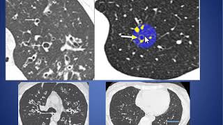 Signs of bronchiectasis [upl. by Rustie]