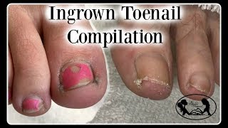 Satisfying Ingrown Toenail Pedicure Compilation [upl. by Ahtar341]