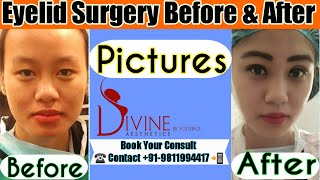 Eyelid Surgery Before and After Pictures [upl. by Adran]