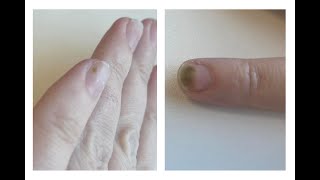 What are Greenies Or Green Nail Syndrome [upl. by Oravla]