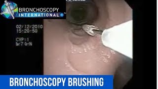 Flexible Bronchoscopy Basic Techniques 5  Brushing [upl. by Leirbag376]