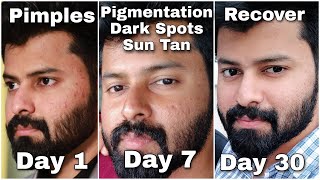 Do you have Dark Spots Pigmentation Just follow this for 100  gauranteed Result 👍  Tamil [upl. by Nylear161]