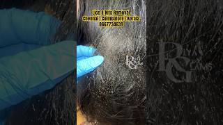 How to remove Lice from hairbest treatment for lice and eggsheavy lice in hairlice removallice 💯 [upl. by Kailey626]