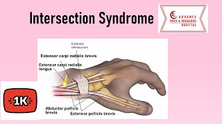 Intersection Syndrome  Crossover Syndrome  Squeakers Wrist [upl. by Virgil]