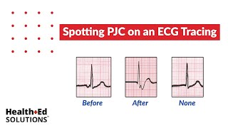 One Quick Question What Are PJCs Premature Junctional Contractions [upl. by Kciv]