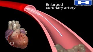 How Balloon Angioplasty is Done Animation  Coronary Angiography Procedure  Stenting in Heart Video [upl. by Raffin694]