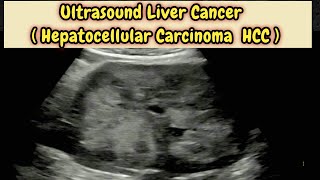 Liver Cancer  Hepatocellular Carcinoma HCC  Hepatoma Ultrasound [upl. by Yartnoed]