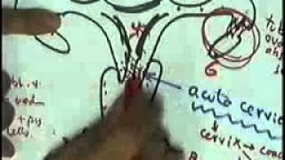 GENITAL 1 gonorrhea cervicitis endometrium DR SAMEH GHAZY [upl. by Tymothy725]