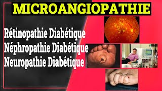 Complications Chroniques du Diabète Microangiopathie Diabétique  Endocrinologie Medicale [upl. by Eirellav]