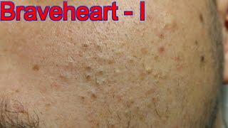 Extraction for Teenage Acne  Part 1 of 3 [upl. by Mcfarland]