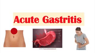 Acute Gastritis Stomach Inflammation  Causes Signs amp Symptoms Diagnosis Treatment [upl. by Ursa391]