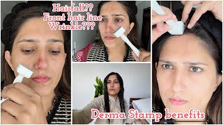 Derma stamp benefits for hair fall amp aging  Hairfall guide by Natasha waqas [upl. by Allenotna]