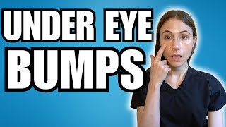 What Are Those Bumps Under The Eyes  Dermatologist Explains [upl. by Holbrooke370]