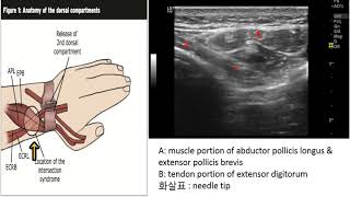 Treatment protocol for intersection syndrome [upl. by Truscott]