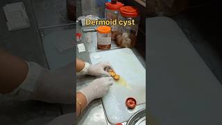 Dermoid cyst scalp dermoidcyst டெர்மாய்டிசிஸ்ட் cyst pathology tissuefixation [upl. by Llenyt]