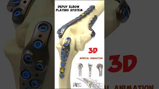 Depuy Elbow Plating System medical 3danimation short biology With Aliya [upl. by Tennos]