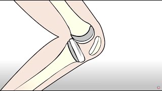 Knee Replacement vs Regenexx Orthopedic Regenerative Treatment [upl. by Tallu47]