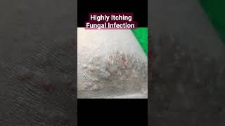 Highly Itching Fungal Infection  Ringworm of Groin  Tinea cruris [upl. by Onstad]